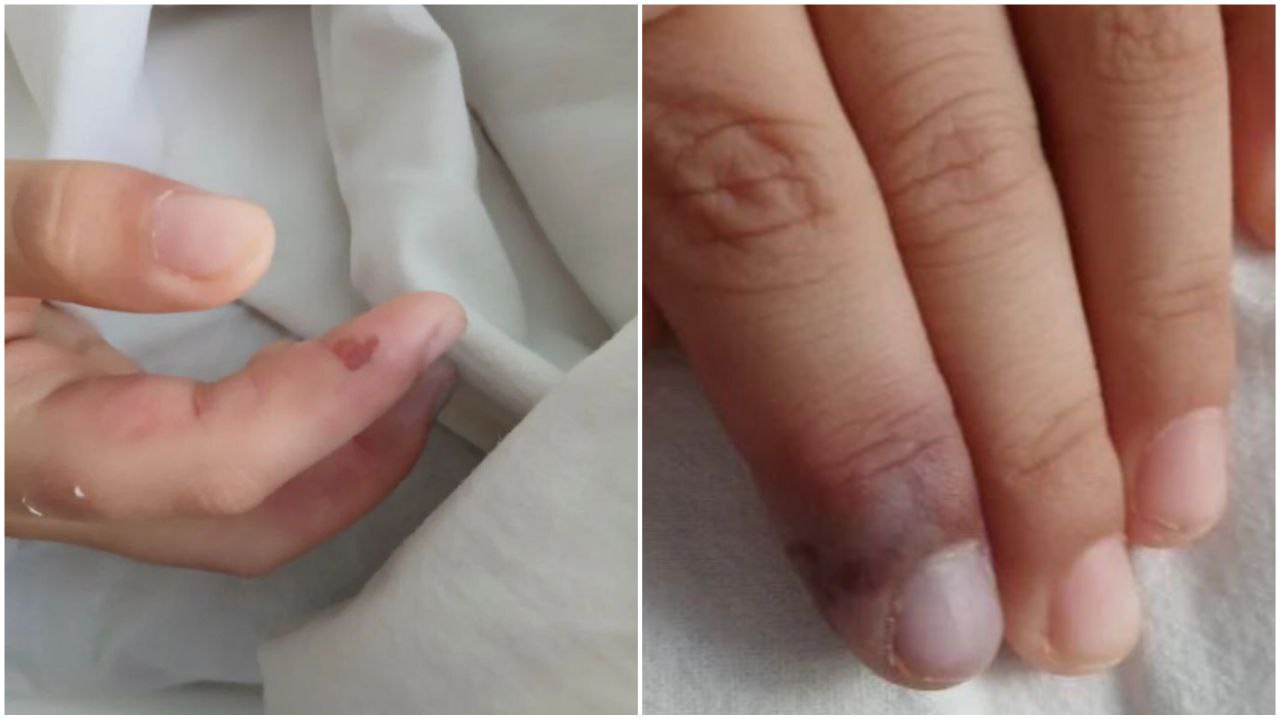 Саратовские врачи спасли спасли девочку с редчайшим заболеванием